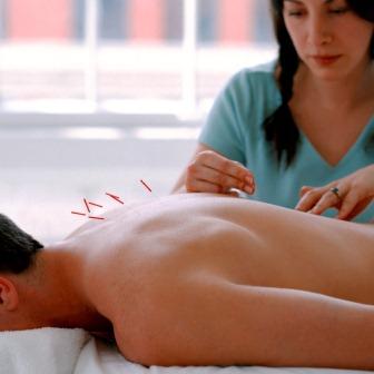 Acupuncture photo